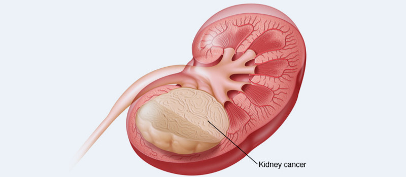 kidney stone disease 1